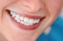 Professional-Teeth-Whitening-by-LA-Smile